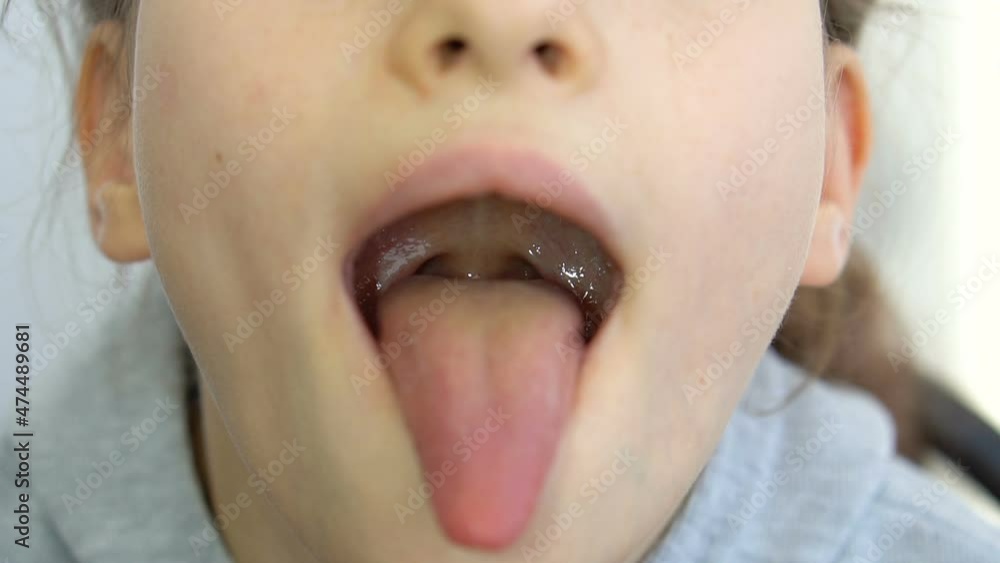 Wide open mouth with a tongue stuck out, view of the uvula and the soft palate of little girl, pediatric dentistry  