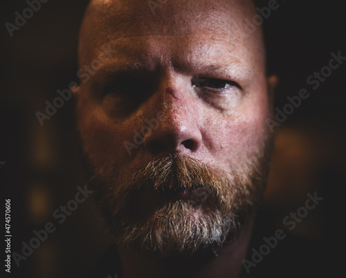 Tough guy, closeup face of man with large cut on the bridge of his nose. Intense look of a fighter. 
