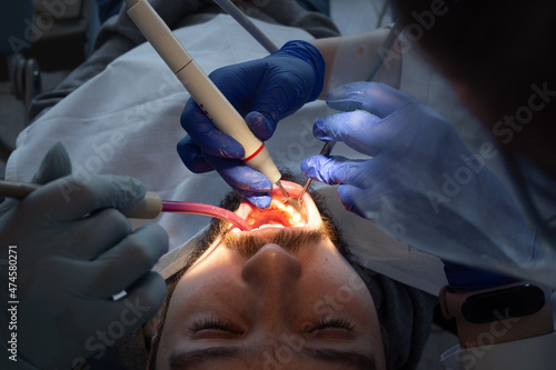 Dentist make ultrasonic teeth cleaning close-up. Removal of tartar and plaque. prevention of dental disease paradontitis and paradantoz. 