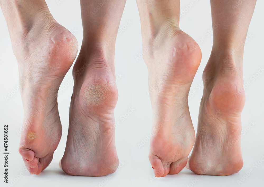 Female beauty heels, feet before and after cosmetic procedure. pedicure and beauty salon concept Female beauty heels, feet before and after cosmetic procedure. pedicure and beauty salon concept