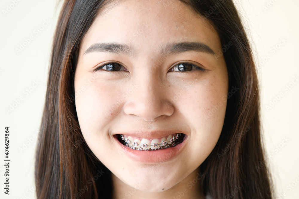 Face of a young woman with braces on her teeth Face of a young woman with braces on her teeth