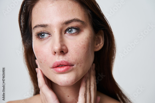 Charming young lady with acne face looking away with pensive expression photo