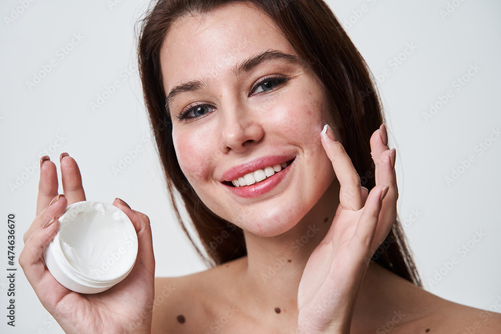 Woman model with acne problem skin holding a cosmetic bottle with moisturizer and smilin Woman model with acne problem skin holding a cosmetic bottle with moisturizer and smilin