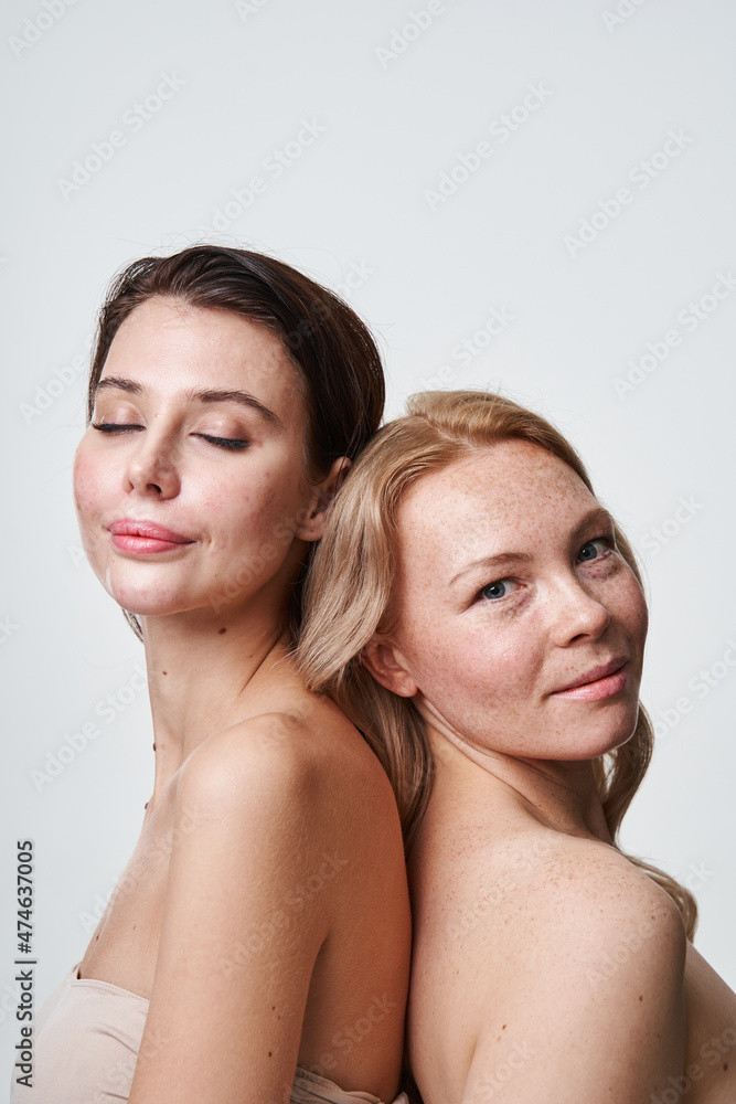 Diverse girls with different skin condition posing for camera in studio Diverse girls with different skin condition posing for camera in studio