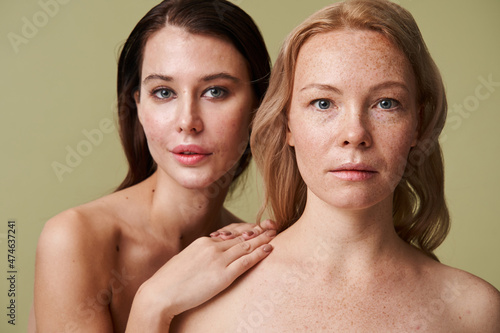 Brunette woman with problematic skin and with naked shoulders embracing blonde woman
