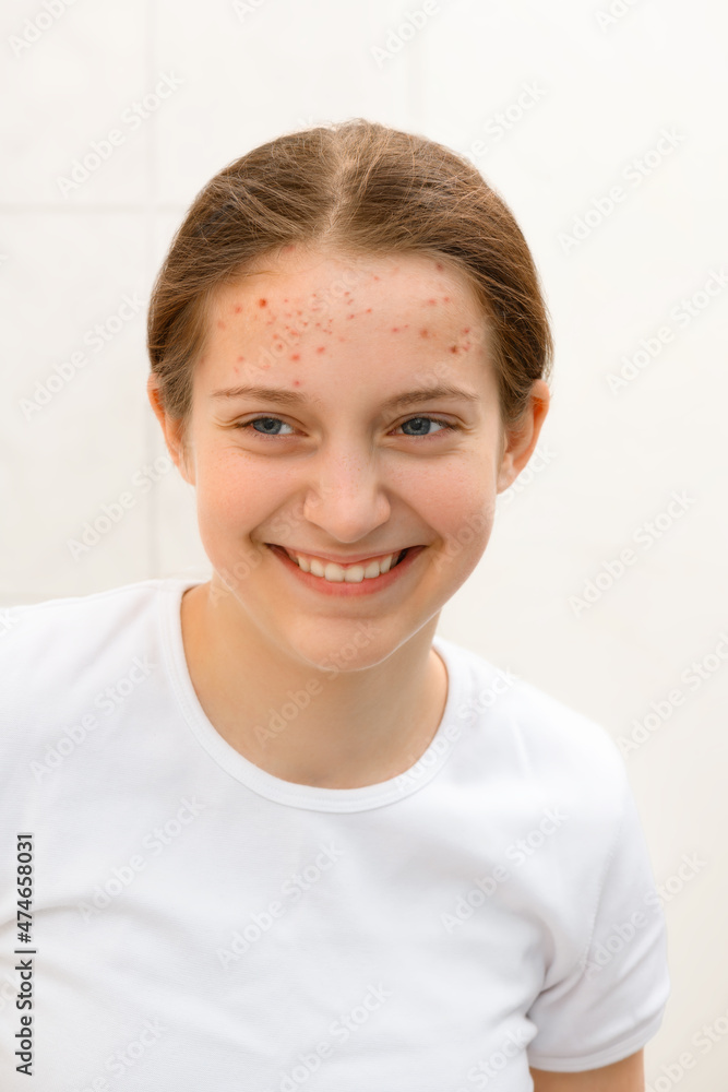 face of a teenage girl with pimples, she looks at herself in the mirror and smiling, acne on the skin, concept of beauty and health face of a teenage girl with pimples, she looks at herself in the mirror and smiling, acne on the skin, concept of beauty and health