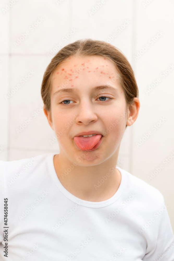 face of a teenage girl with pimples, she looks at herself in the mirror, grimacing and having fun, acne on the skin, concept of beauty and health face of a teenage girl with pimples, she looks at herself in the mirror, grimacing and having fun, acne on the skin, concept of beauty and health