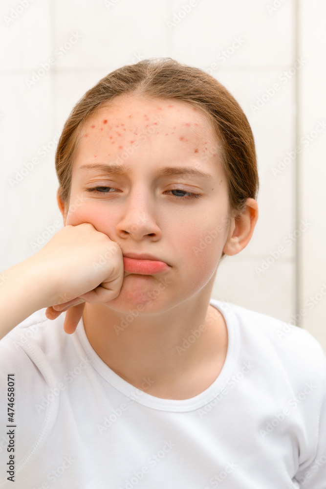 face of a teenage girl with pimples, she looks at herself in the mirror, grimacing and having fun, acne on the skin, concept of beauty and health face of a teenage girl with pimples, she looks at herself in the mirror, grimacing and having fun, acne on the skin, concept of beauty and health