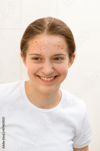 face of a teenage girl with pimples, she looks at herself in the mirror and smiling, acne on the skin, concept of beauty and health