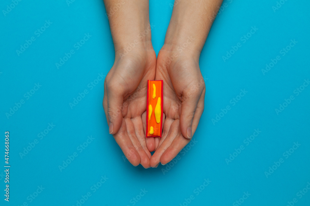 Atherosclerosis Disease Narrowing Of Arteries Due To Plaque Buildup On