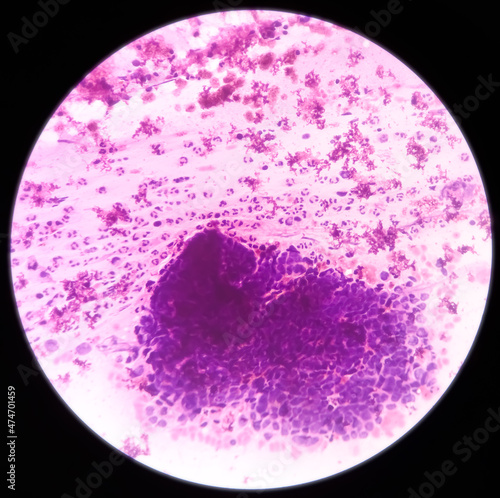 High grade squamous intraepithelial lesion(HSIL). Photomicrograph of conventional pap smear. Reactive cellular changes associated with severe inflammation. Focus view.