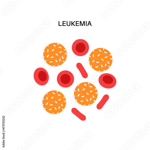 Leukemia cancer disease