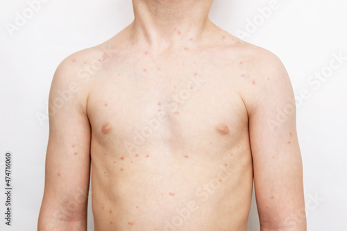 A cropped shot of a child with a red rash on his body isolated on a white background. Chickenpox, measles, allergies, dermatitis, herpes, virus. Medical concept