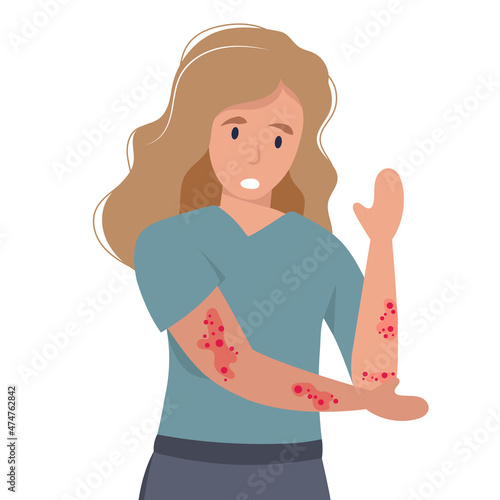 Woman with strong allergy symptoms. Cartoon sad character scratching skin, itching and suffering. Virus disease and eczema concept. Flat vector illustration.
