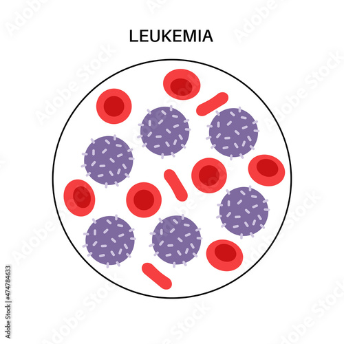 Leukemia cancer disease