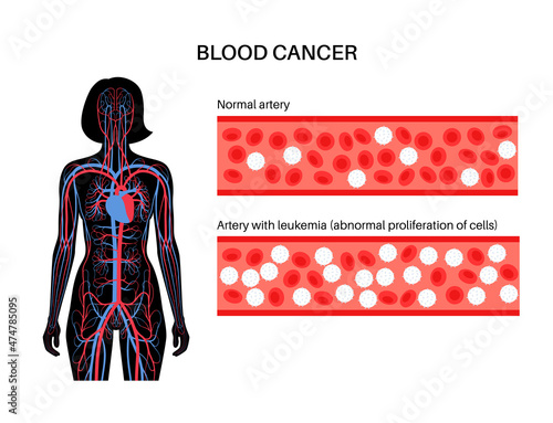 Leukemia cancer disease