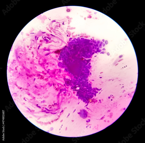 Pap's smear pap stain Microscopic 100x Zoom show High-grade squamous intraepithelial lesion (HSIL) is a pre-cancerous, sexually transmitted disease caused by a virus called human papillomavirus (HPV).