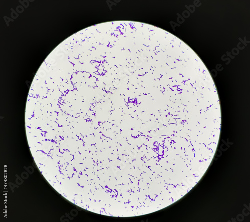 Fotografija Streptococcus pyogenes infected in aged patient, showing of gram's stain from positive hemoculture