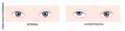Hypertropia. Vertical strabismus before and after surgery. Human eyes healthy and with upward gaze position. Double vision. Vector cartoon illustration. photo