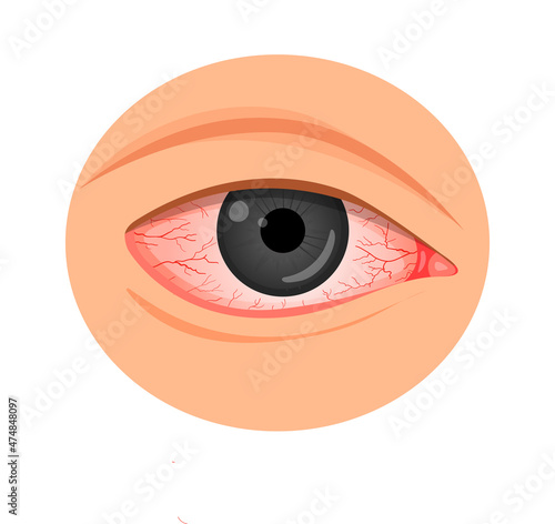 Eye irritation. konyuktevitis, keratitis, allergies, uveitis.