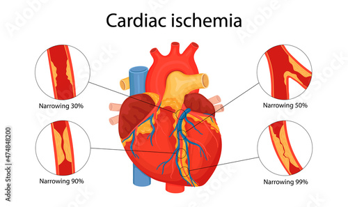 cardiac ischemia. anatomical illustration drawn in cartoon style