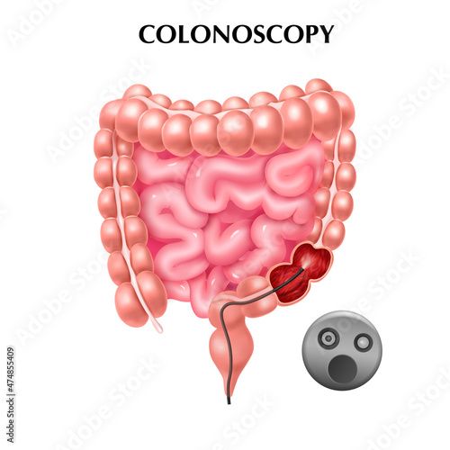 Colonoscopy Realistic Poster