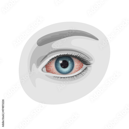 Reddened human eye with many distinct blood vessels
