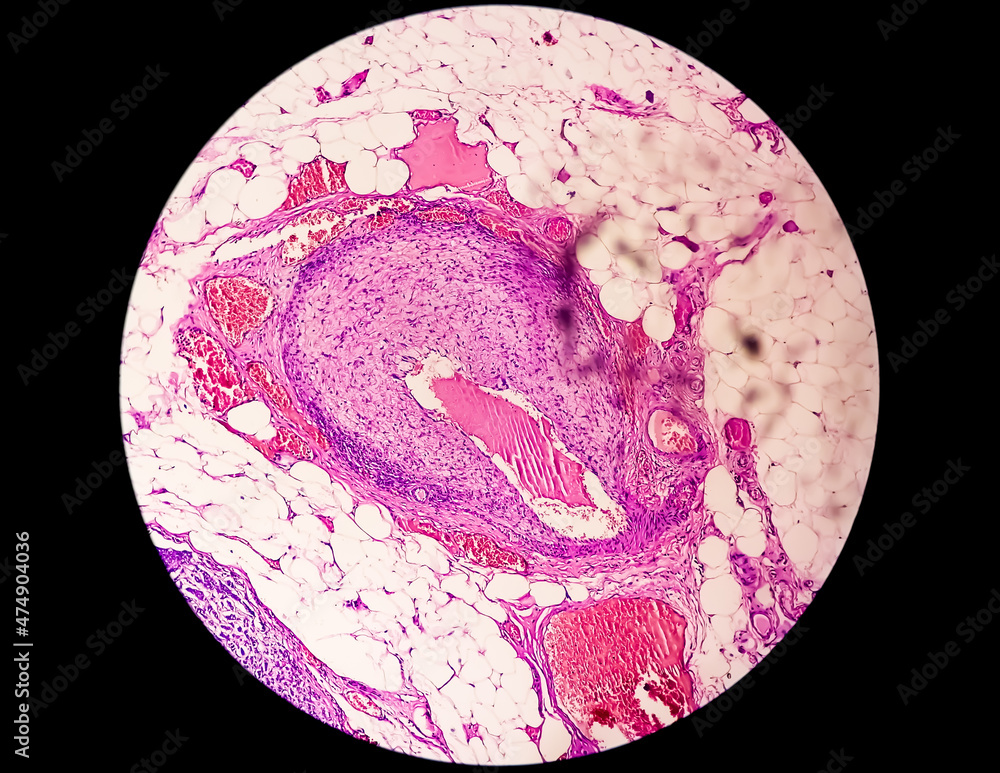 Breast Cancer Awareness Microscopic image (photomicrograph) showing
