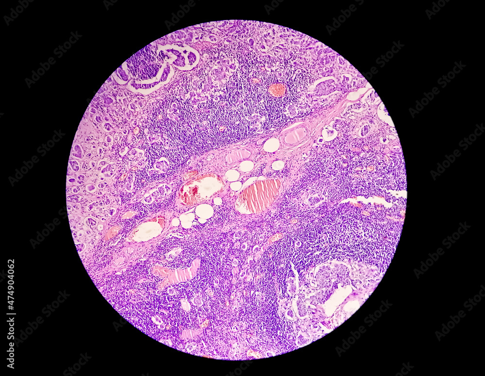 Breast Cancer Awareness Microscopic image (photomicrograph) showing