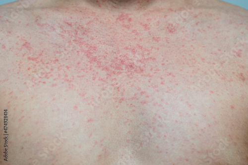 Dermatitis rash viral disease with immunodeficiency on body of young adult asian, scratch with itch