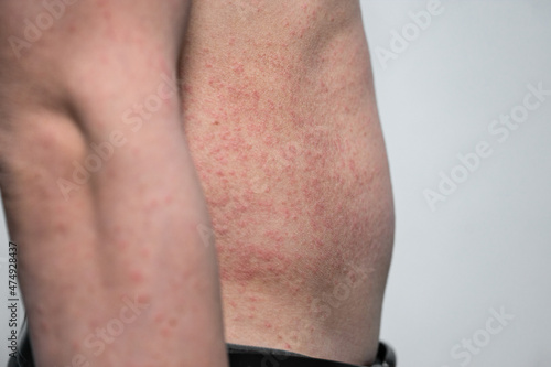 Dermatitis rash viral disease with immunodeficiency on body of young adult asian, scratch with itch © Mumemories