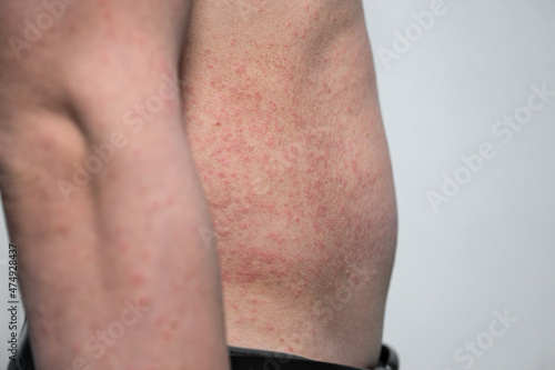 Dermatitis rash viral disease with immunodeficiency on body of young adult asian, scratch with itch photo