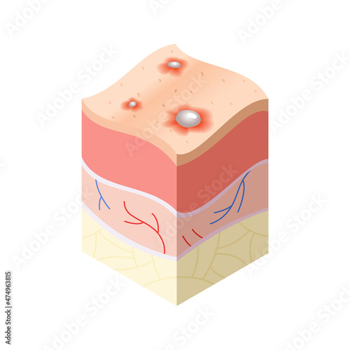 Skincare medical concept. Problems in cross-section of human skin horizontal layers structure. Anatomy illustrative model