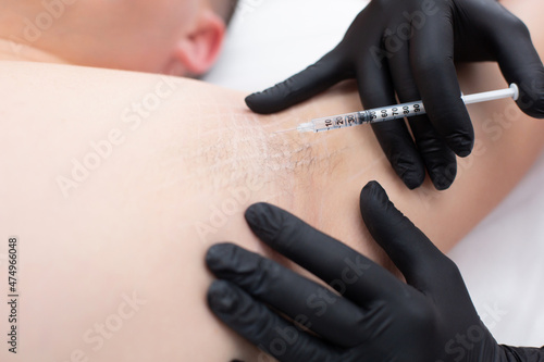 Closeup of a doctor hands in medical gloves with a syringe performs botox injections into the armpit for a young man to prevent excessive sweating