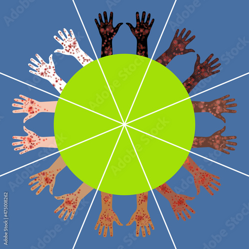 8 different skin colors of hands pairs. Palms up around circle. Painful rash in varying pigmentation people. Dermatoses affect skin regardless of its color. Skin diseases with racial pigmentation.