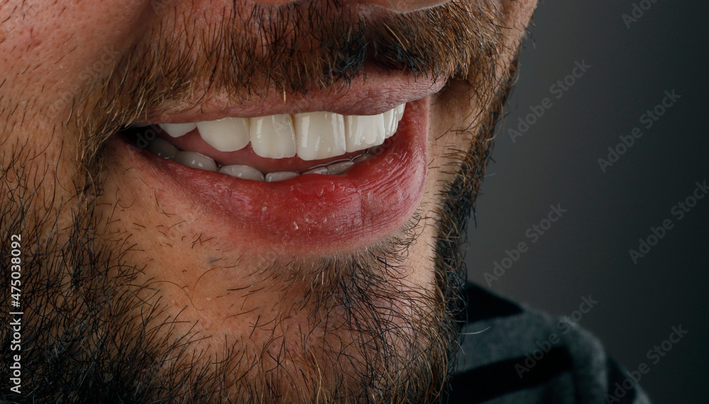 Smile design with laminate veneers. Smile design with laminate veneers.