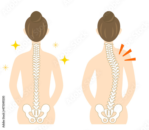 Illustration of the back of a woman with scoliosis and a bent spine.