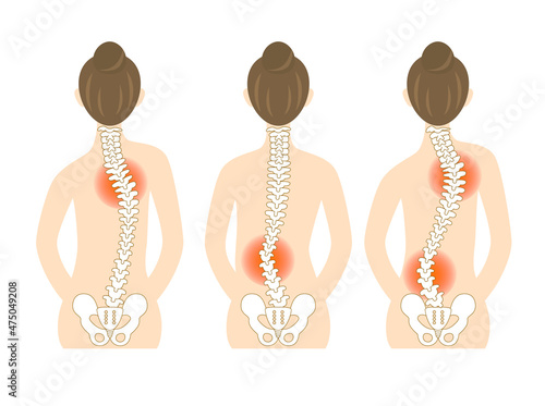 Illustration of the back of a woman with scoliosis and a bent spine.
