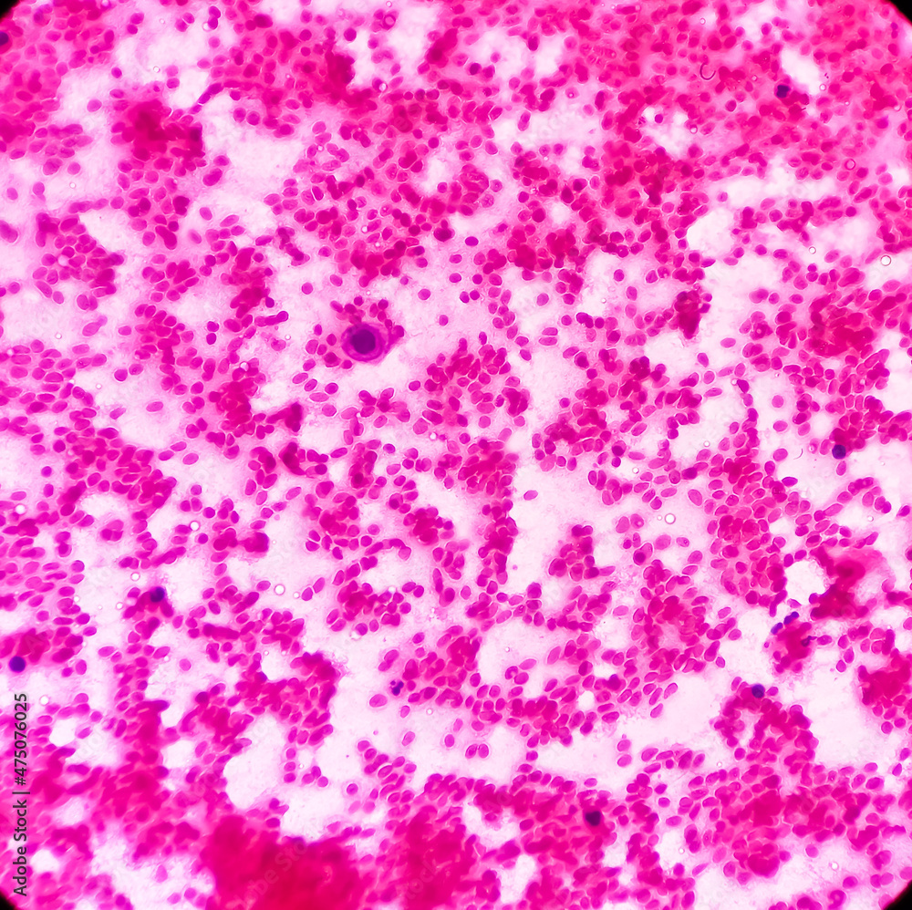 Parotid swelling, malignant cell consistent with mucoepidermoid carcinoma, squamous cells, chronic inflammatory cells and hemorrhage background, FNAC Parotid swelling, malignant cell consistent with mucoepidermoid carcinoma, squamous cells, chronic inflammatory cells and hemorrhage background, FNAC