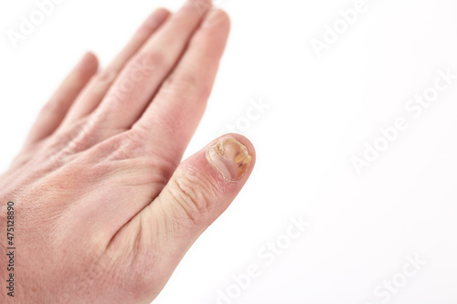Nail fungus on hands disease. Fungal infection on nails hands, finger with onychomycosis, damage on human hands photo