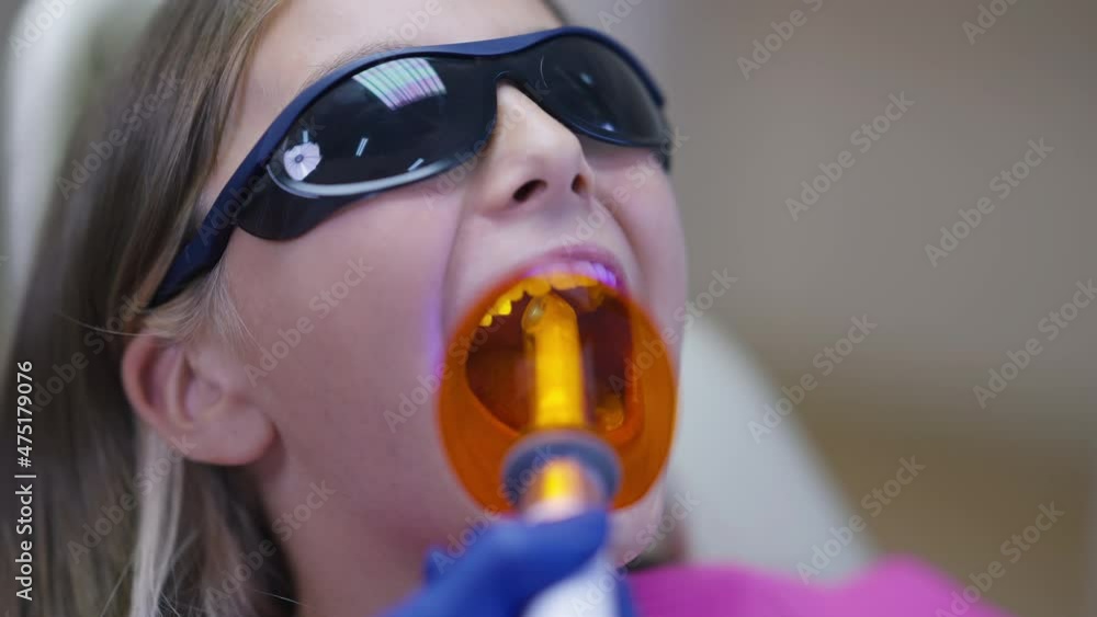 Closeup dental UV curing light in doctor hand with teenage patient in