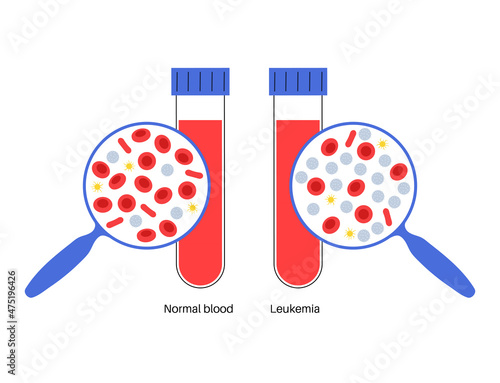 Leukemia cancer disease