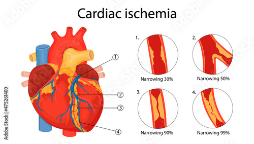 cardiac ischemia. anatomical illustration drawn in cartoon style photo