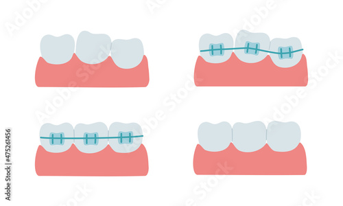 Teeth alignment with dental braces. Stages of orthodontic treatment. Crooked teeth, in brackets and healthy. Isolated flat vector illustration. 