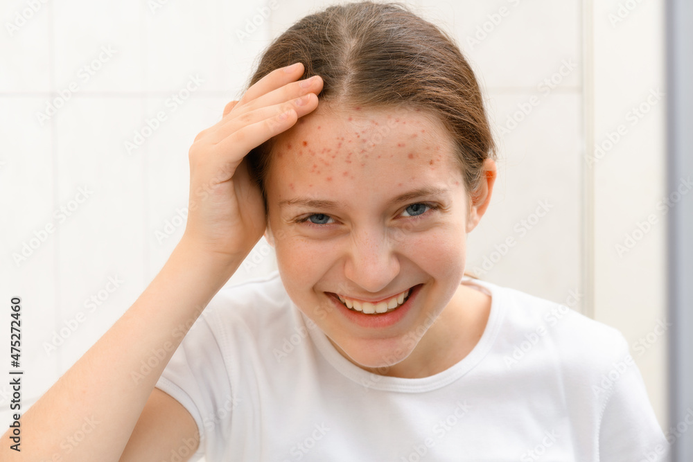 portrait of a teenage girl touches her face with pimples, acne on the skin, she laughs and has good emotions portrait of a teenage girl touches her face with pimples, acne on the skin, she laughs and has good emotions