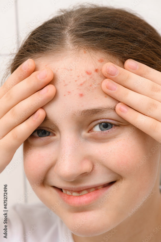 Fototapeta premium portrait of a teenage girl touches her face with pimples, acne on the skin, she laughs and has good emotions