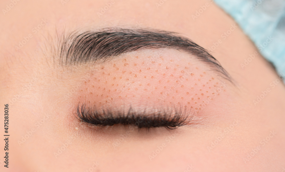 Obraz premium Cosmetic procedure for lifting the skin of the eyelids of Asian eyes. Non-surgical blepharoplasty with plasma IQ apparatus. Facial rejuvenation cosmetology. Beautician makes a cosmetic procedure.