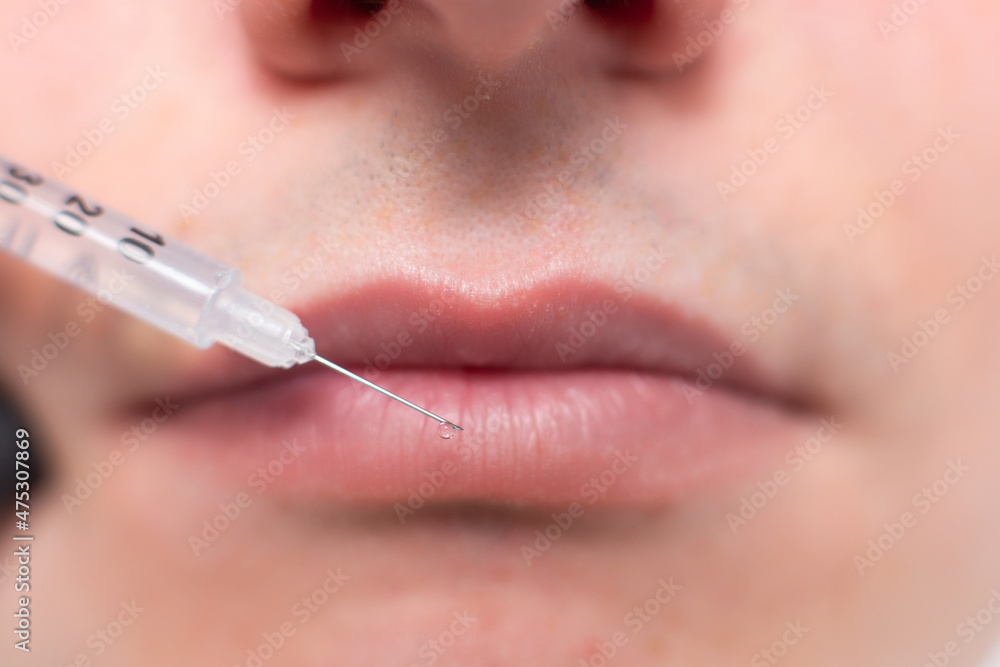 Obraz premium Close up of a drop of a drug falling from a syringe needle on the lips of a male patient of a cosmetology office. Rejuvenation procedure, injections of hyaluronic acid to moisturize the lips