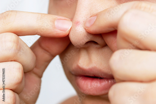Cropped shot of a woman squeezing out a red inflamed pimple with her hands isolated on a white background. Acne problem, comedones. Cosmetology dermatology concept