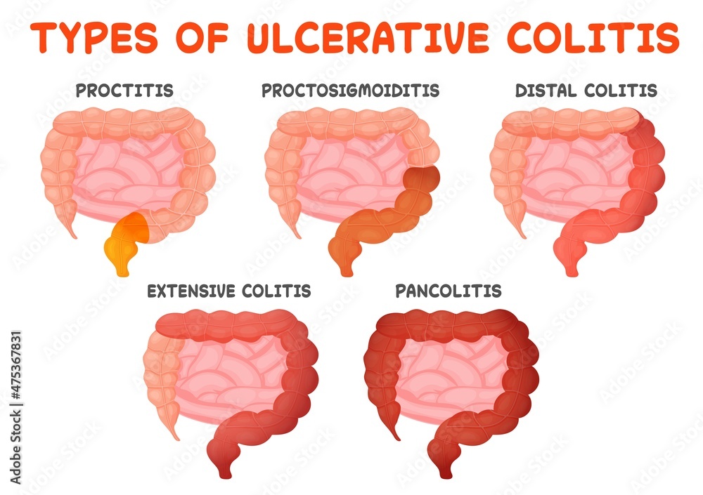 Ulcerative Colitis Types Gut Disease Intestine Inflammation From Proctitis To Pancolitis 8654